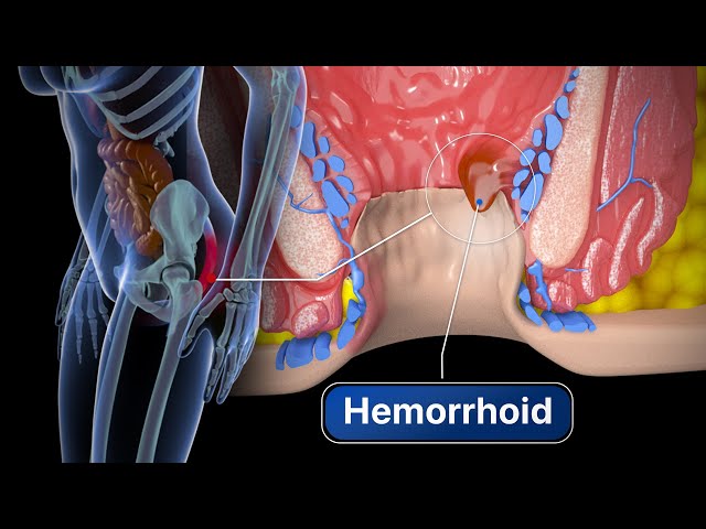 Hemorrhoid Treatment Procedure in Dwarka,Delhi