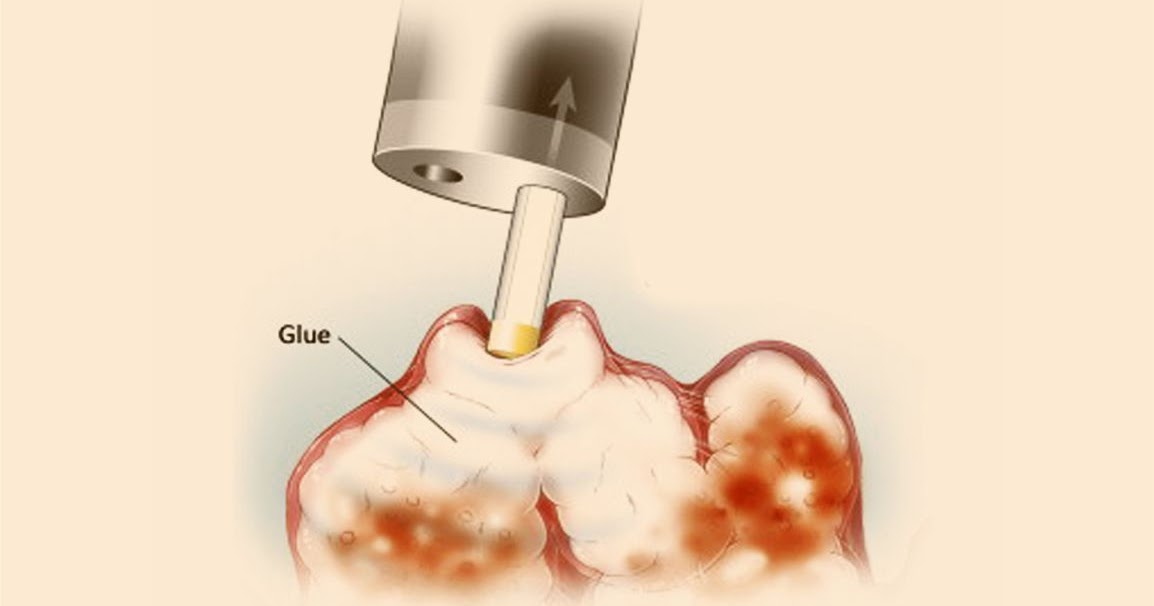 Colonoscopy Glue Injection in Dwarka,Delhi